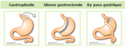 Chirurgie bariatrique : gastrectomie, sleeve et by-pass